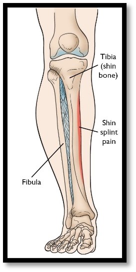 shin splints 2.jpg